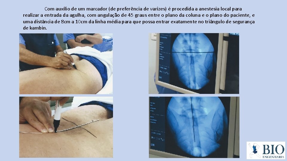 Com auxílio de um marcador (de preferência de varizes) é procedida a anestesia local