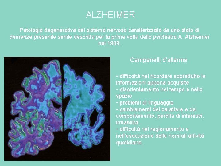 ALZHEIMER Patologia degenerativa del sistema nervoso caratterizzata da uno stato di demenza presenile descritta