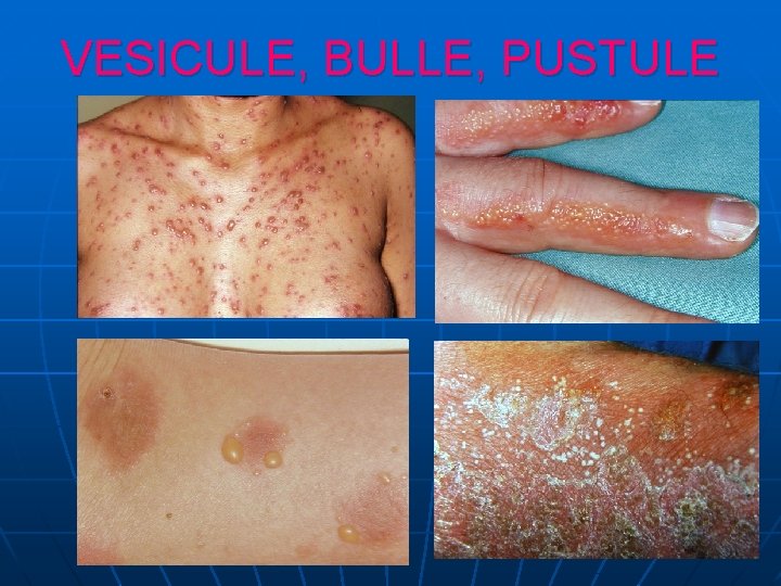 VESICULE, BULLE, PUSTULE VESICULE, BULLE, PUSTULE