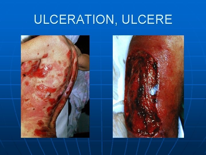 ULCERATION, ULCERE ULCERATION, ULCERE