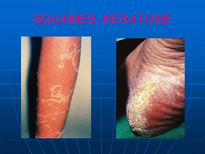 SQUAMES, KERATOSE SQUAMES, KERATOSE