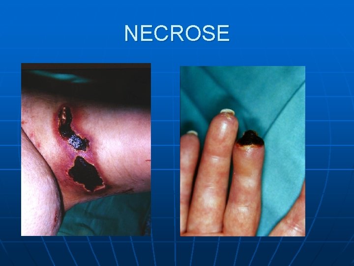 NECROSE NECROSE