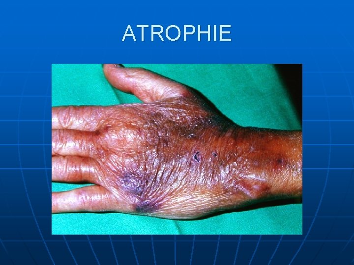 ATROPHIE ATROPHIE