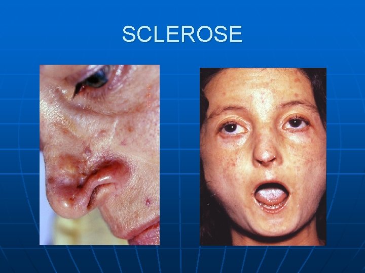 SCLEROSE SCLEROSE