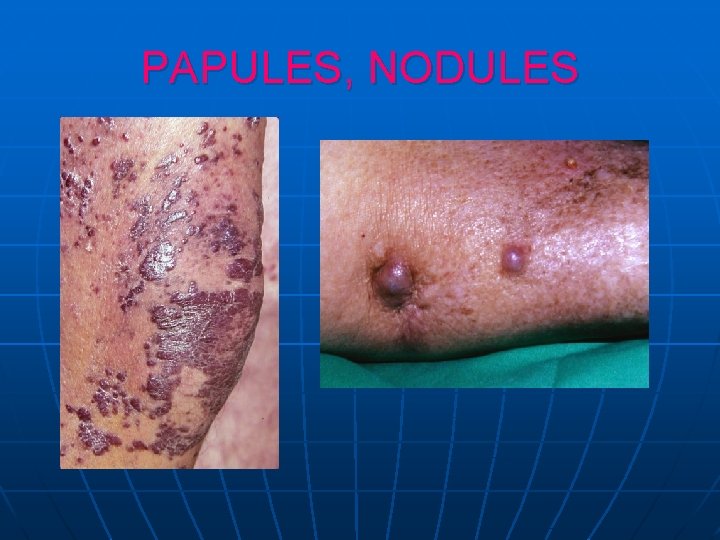PAPULES, NODULES PAPULES, NODULES