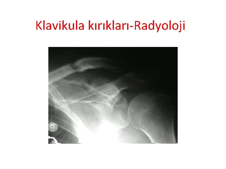 Klavikula kırıkları-Radyoloji 