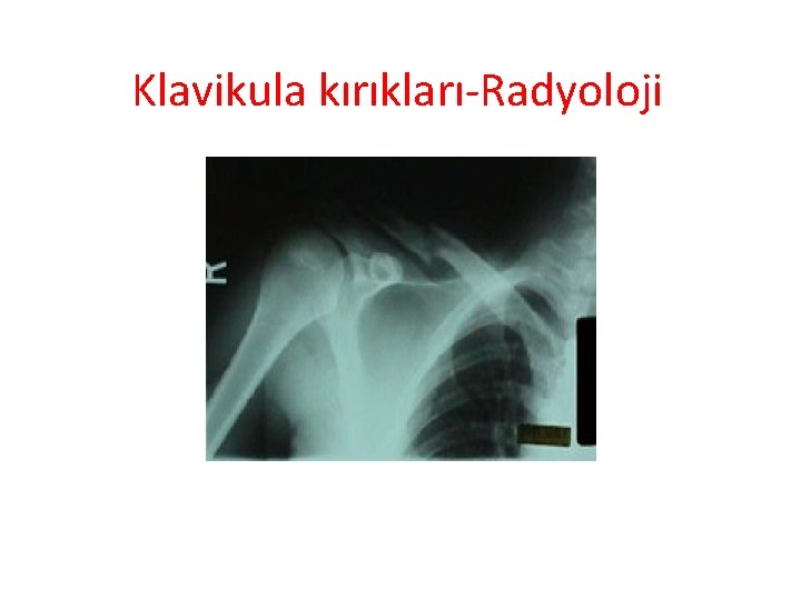 Klavikula kırıkları-Radyoloji 