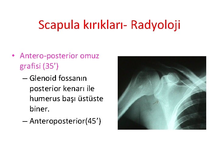 Scapula kırıkları- Radyoloji • Antero-posterior omuz grafisi (35’) – Glenoid fossanın posterior kenarı ile