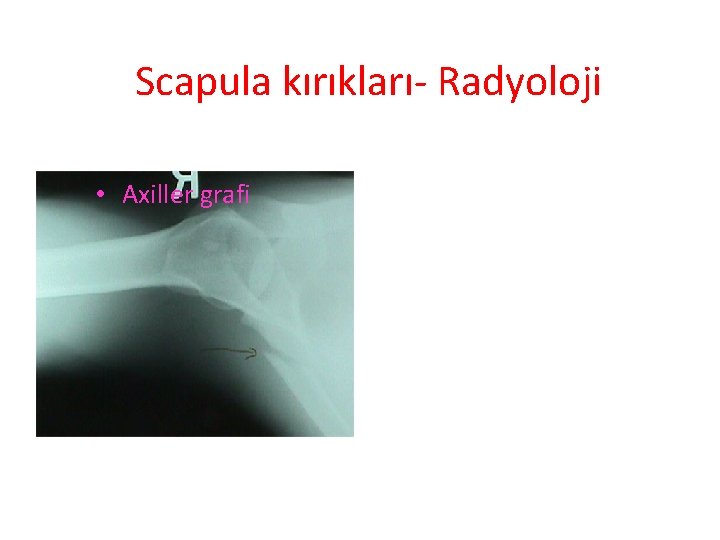 Scapula kırıkları- Radyoloji • Axiller grafi 