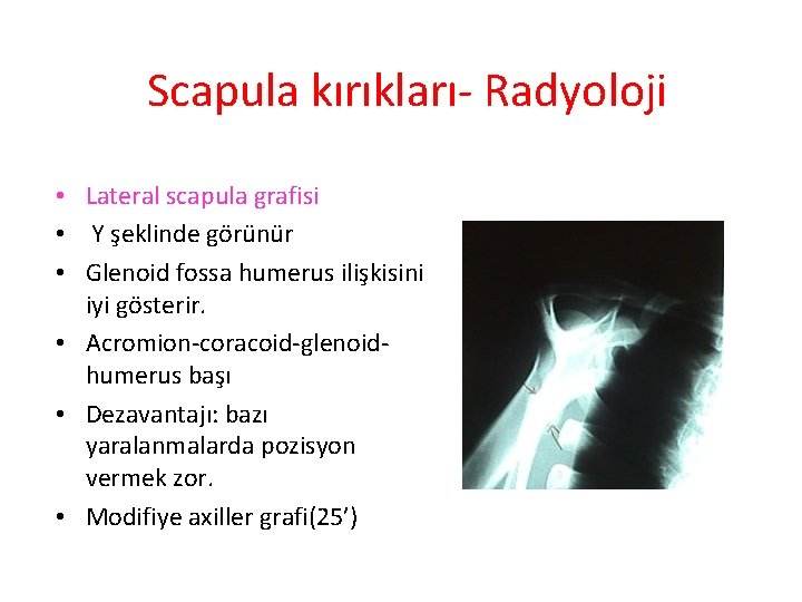 Scapula kırıkları- Radyoloji • Lateral scapula grafisi • Y şeklinde görünür • Glenoid fossa