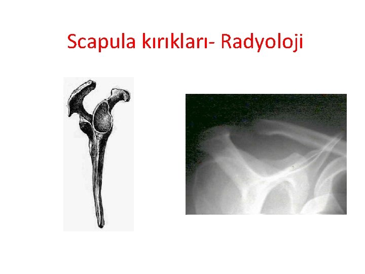 Scapula kırıkları- Radyoloji 