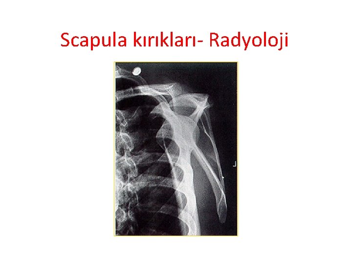 Scapula kırıkları- Radyoloji 