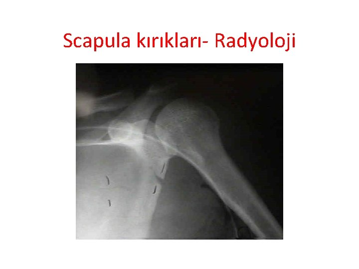 Scapula kırıkları- Radyoloji 