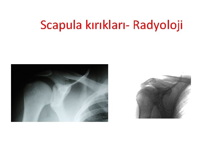 Scapula kırıkları- Radyoloji 