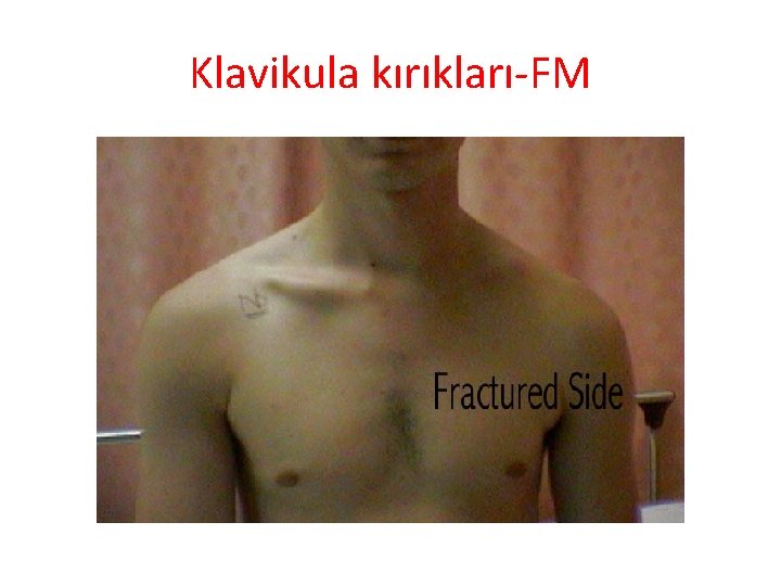 Klavikula kırıkları-FM 