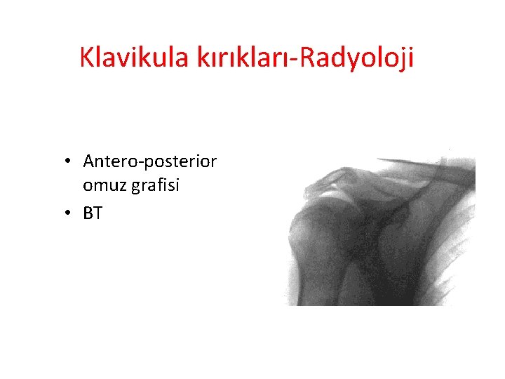 Klavikula kırıkları-Radyoloji • Antero-posterior omuz grafisi • BT 