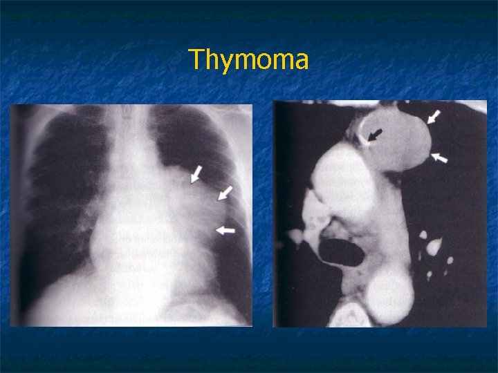 Thymoma 