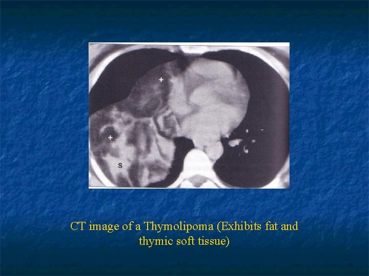 CT image of a Thymolipoma (Exhibits fat and thymic soft tissue) 