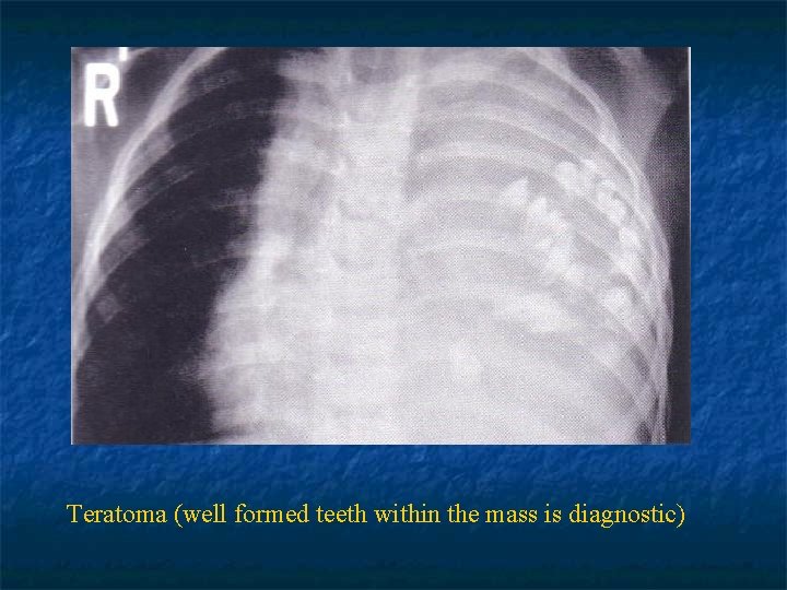 Teratoma (well formed teeth within the mass is diagnostic) 