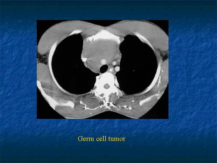 Germ cell tumor 