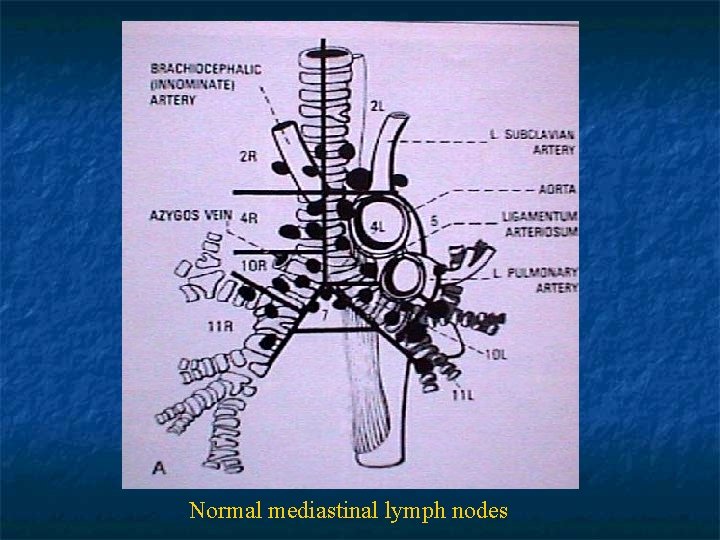 Normal mediastinal lymph nodes 