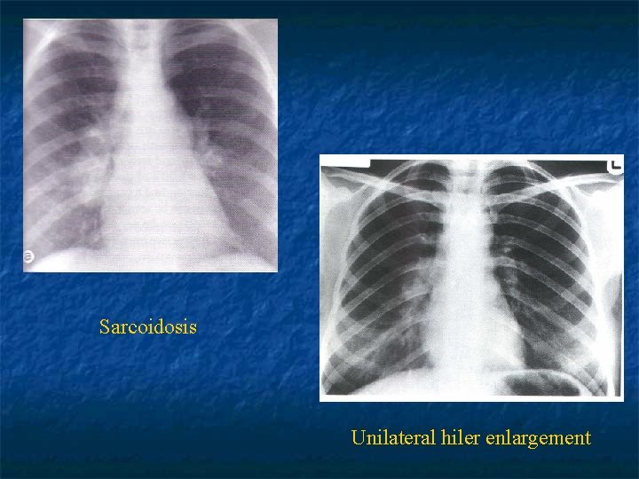 Sarcoidosis Unilateral hiler enlargement 