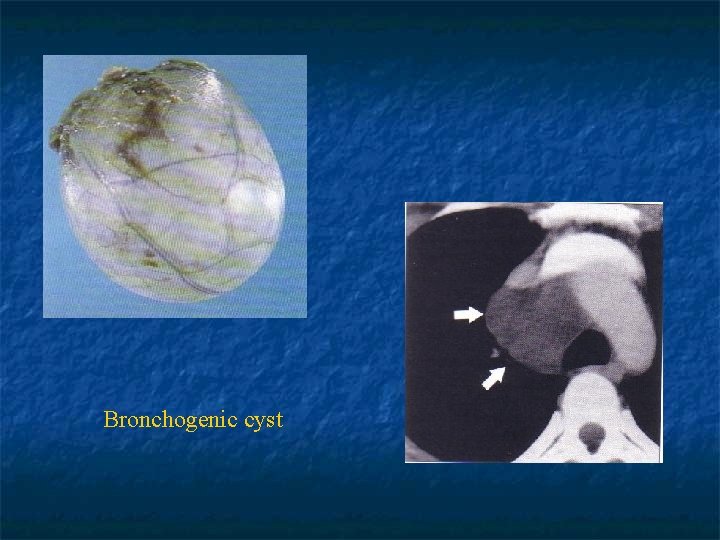 Bronchogenic cyst 