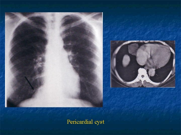 Pericardial cyst 