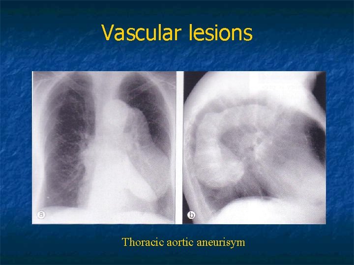 Vascular lesions Thoracic aortic aneurisym 