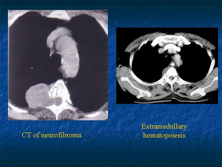 CT of neurofibroma Extramedullary hematopoiesis 