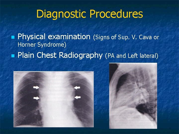 Diagnostic Procedures n Physical examination (Signs of Sup. V. Cava or Horner Syndrome) n