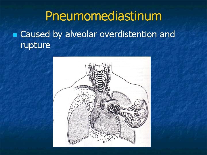 Pneumomediastinum n Caused by alveolar overdistention and rupture 