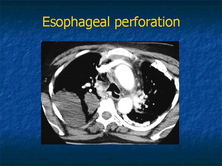 Esophageal perforation 