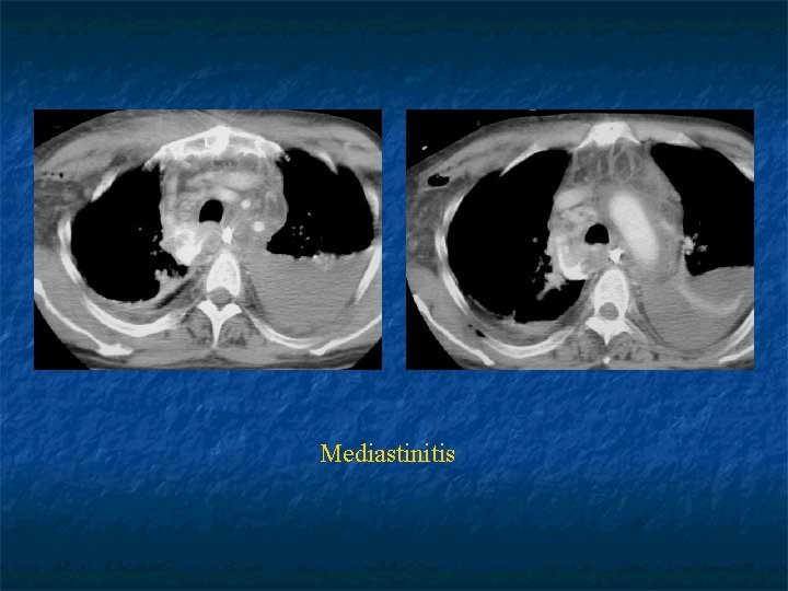 Mediastinitis 