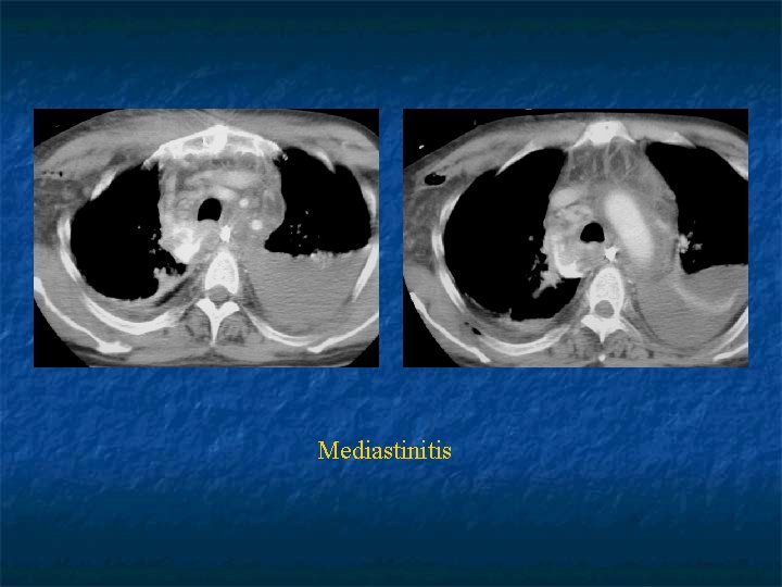 SURGICAL DISORDERS OF MEDIASTINUM AND DIAPHRAGM Sina Ercan