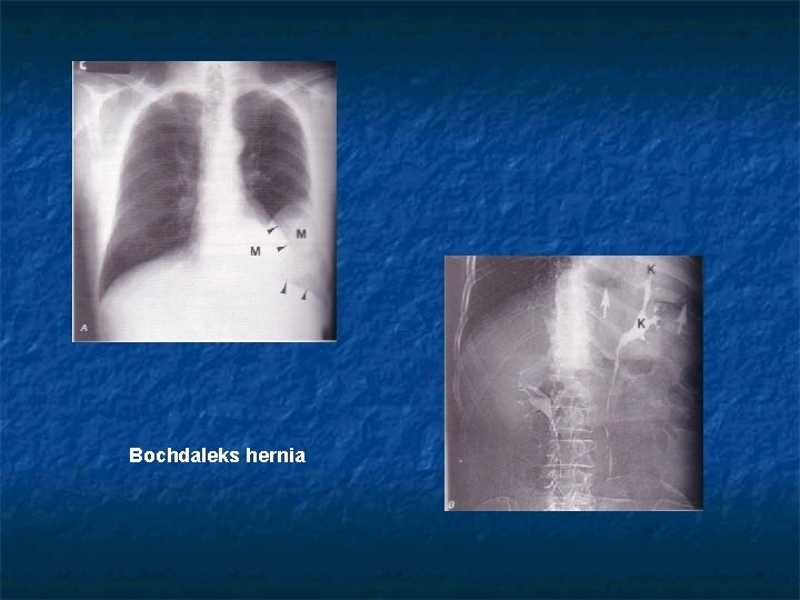 Bochdaleks hernia 