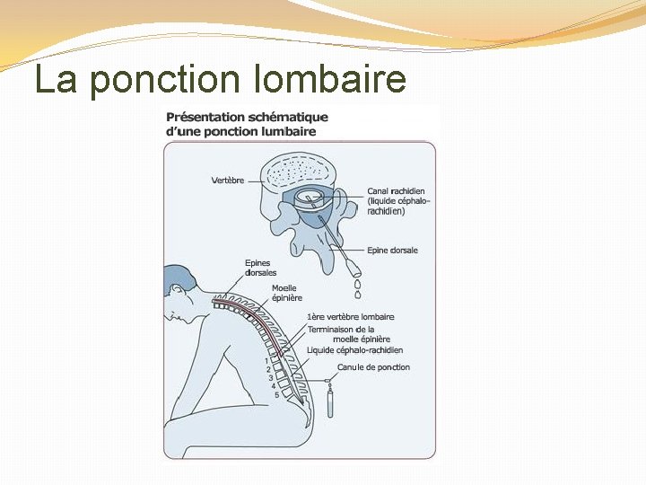 La ponction lombaire 