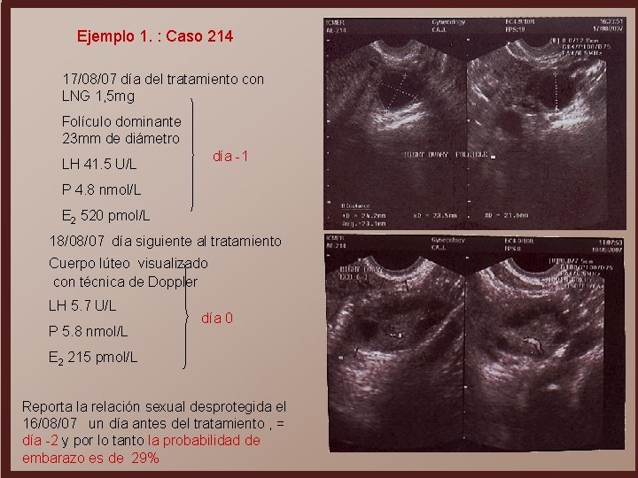 Ejemplo 1. : Caso 214 17/08/07 día del tratamiento con LNG 1, 5 mg