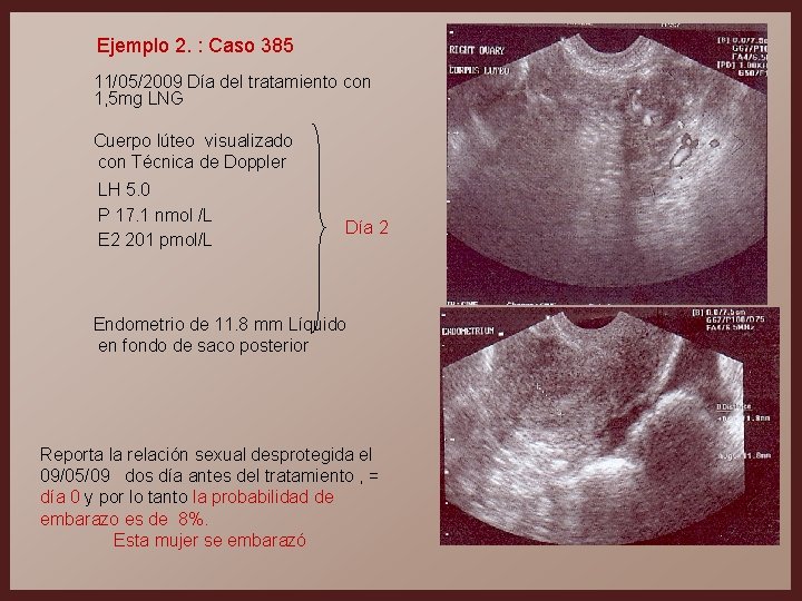 Ejemplo 2. : Caso 385 11/05/2009 Día del tratamiento con 1, 5 mg LNG