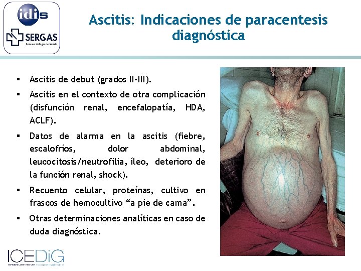 Ascitis: Indicaciones de paracentesis diagnóstica § Ascitis de debut (grados II-III). § Ascitis en
