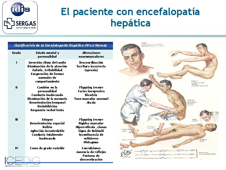 El paciente con encefalopatía hepática Clasificación de la Encefalopatía Hepática (West Haven) Grado Estado