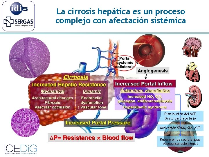 La cirrosis hepática es un proceso complejo con afectación sistémica Disminución del VCE Gasto