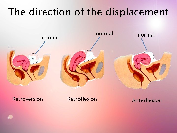 The direction of the displacement normal Retroversion normal Retroflexion normal Anterflexion The direction of the displacement normal Retroversion normal Retroflexion normal Anterflexion