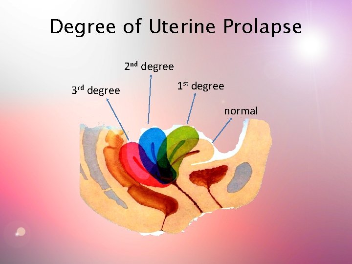 Degree of Uterine Prolapse 2 nd degree 3 rd degree 1 st degree normal Degree of Uterine Prolapse 2 nd degree 3 rd degree 1 st degree normal