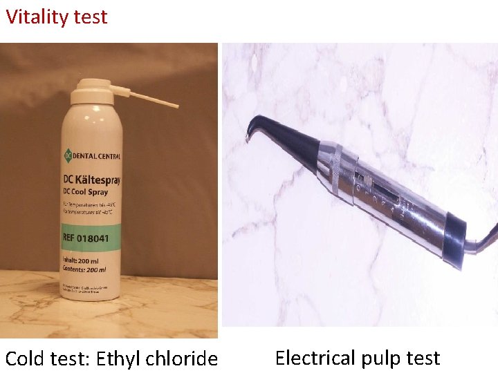 Vitality test Cold test: Ethyl chloride Electrical pulp test 
