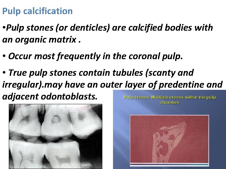 Pulp calcification • Pulp stones (or denticles) are calcified bodies with an organic matrix.