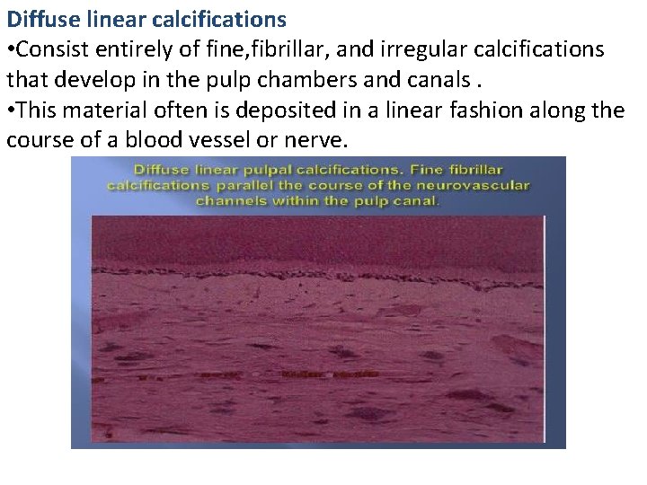 Diffuse linear calcifications • Consist entirely of fine, fibrillar, and irregular calcifications that develop