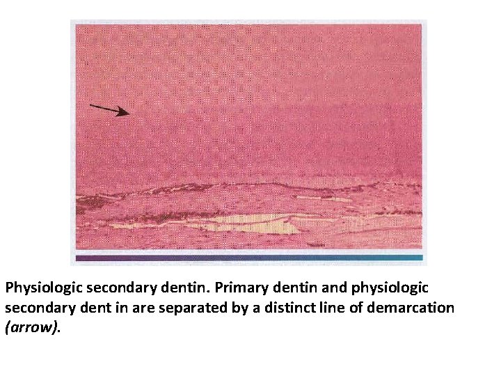 Physiologic secondary dentin. Primary dentin and physiologic secondary dent in are separated by a