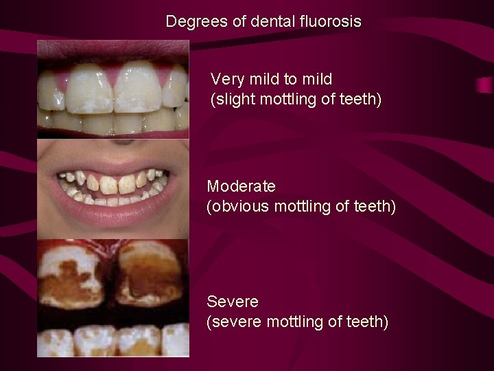 Degrees of dental fluorosis Very mild to mild (slight mottling of teeth) Moderate (obvious