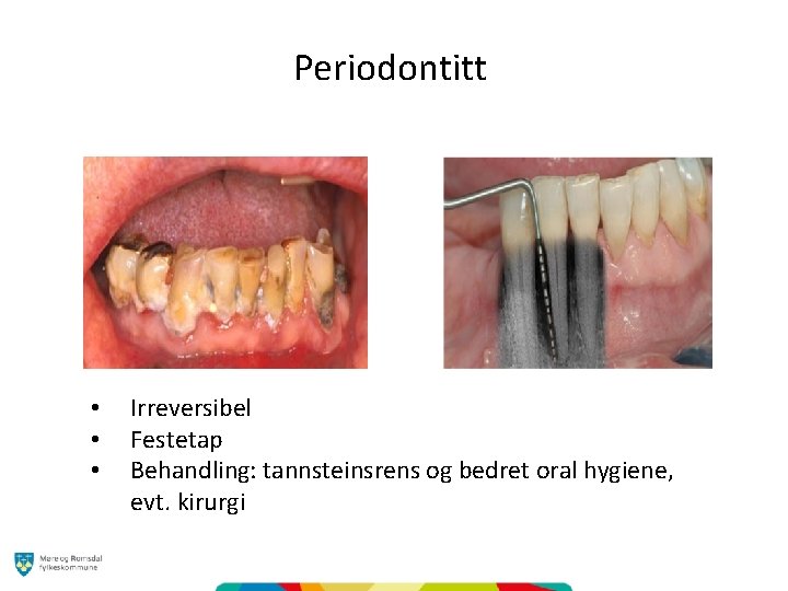 Periodontitt • • • Irreversibel Festetap Behandling: tannsteinsrens og bedret oral hygiene, evt. kirurgi